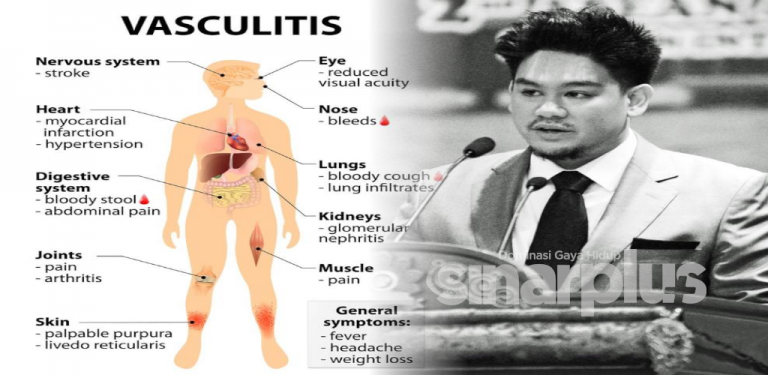 Punca kemangkatan putera Sultan Brunei, penyakit vaskulitis yang ramai tak tahu