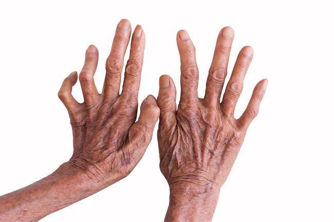 Penyakit berjangkit kronik antara tertua di dunia, KKM kongsi fakta mengenai penyakit kusta