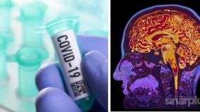 Covid-19: Penyelidik kaji kesan otak pada bekas pesakit. Penemuan mereka sangat mengejutkan...