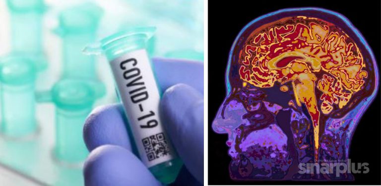 Covid-19: Penyelidik kaji kesan otak pada bekas pesakit. Penemuan mereka sangat mengejutkan...