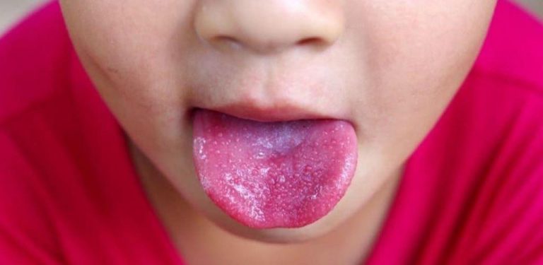Warna lidah terang, berbiji macam strawberi, petanda masalah kesihatan serius