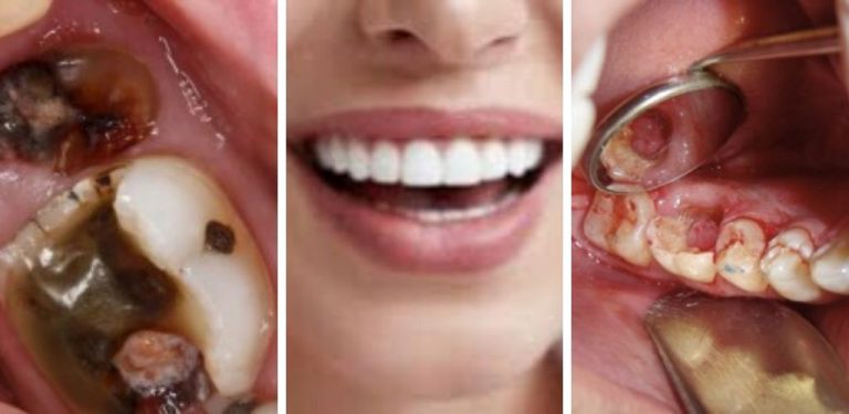Bakteria gigi boleh berjangkit, hati-hatilah bila kucup pasangan, anak-anak