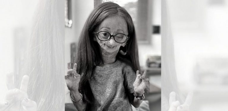 Hidap penyakit ‘rare’ progeria, 1 dalam 4 juta, YouTuber Adalia Rose meninggal dunia pada usia 15 tahun