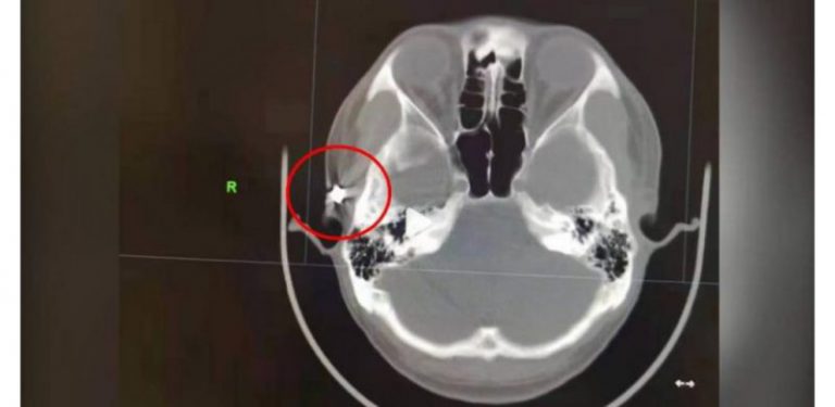 Kerap sakit kepala berpanjangan, hasil MRI menunjukkan peluru tertanam dalam kepala 20 tahun lalu