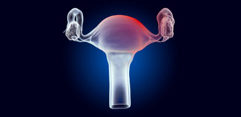 Wanita terpaksa buang rahim akibat ketumbuhan fibroid. Berikut fakta yang perlu kaum Hawa tahu